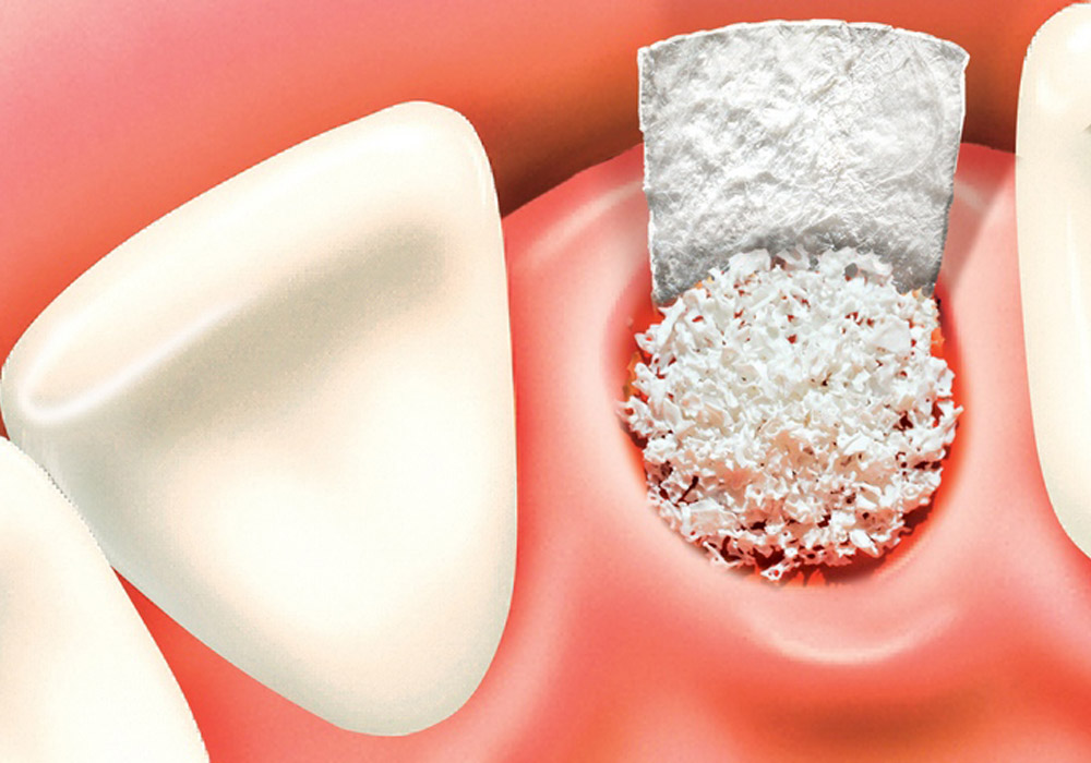 bone grafting