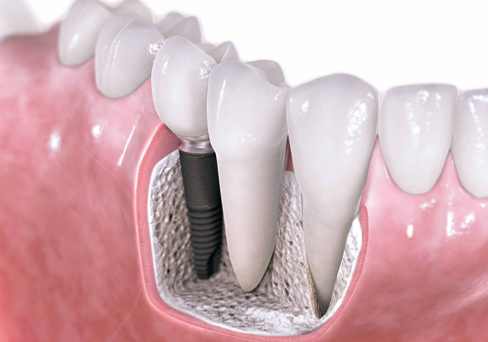 dental implants